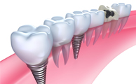 インプラント治療